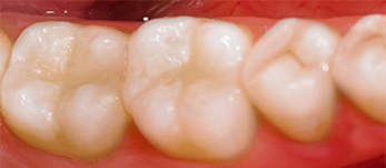 Bonded-White-Fillings