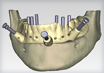 Computer-Guided-Surgery-02