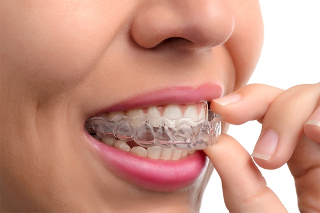 clear-aligners