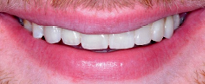 dental-implants-after