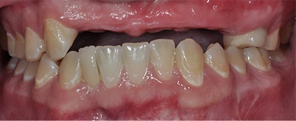 dental-implants-before