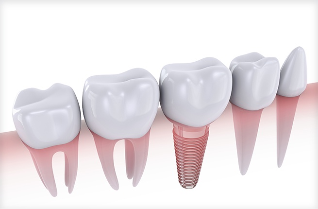 dental-implants