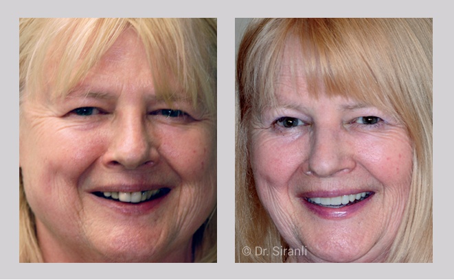 Smile makeover gallery