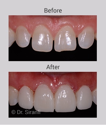 Smile makeover gallery