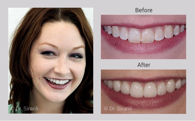 Smile makeover gallery