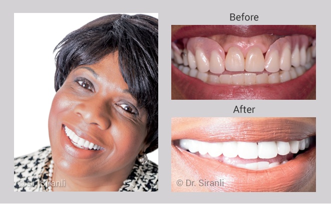 Smile makeover gallery