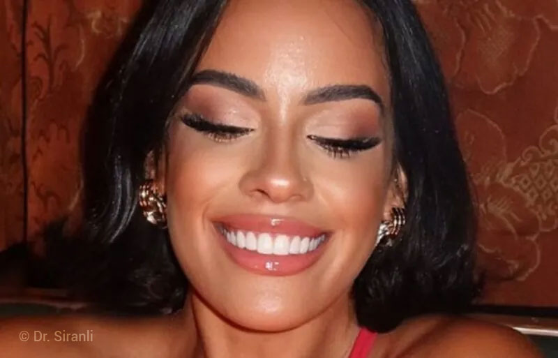 lp-veneers-row4-smile-1-800×513.jpg