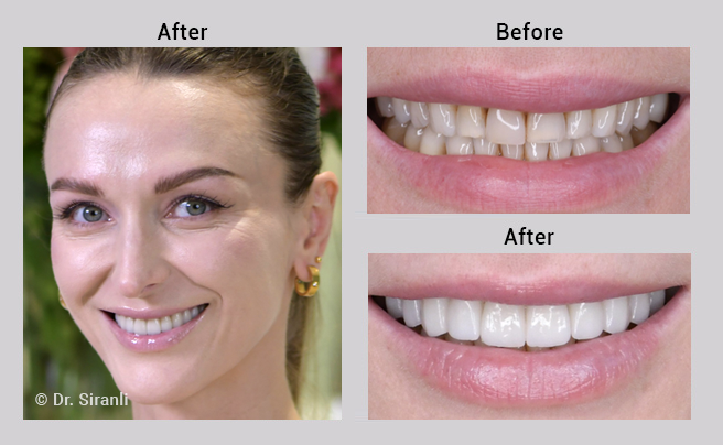 Siranli Porcelain Veneers